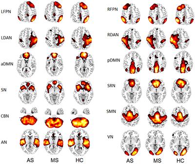 Functional Network Connectivity Patterns between Idiopathic Generalized Epilepsy with Myoclonic and Absence Seizures